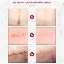 Pei Mei Collagen Scar and Acne Mark Removal Repair Gel